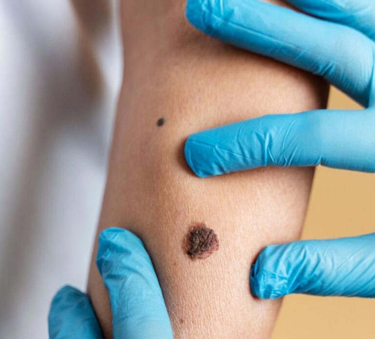 Cofepris aprueba ensayo clínico para vacuna innovadora contra melanoma
